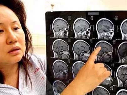 Một bệnh nhân với những con sán trong não (điểm trắng trên ảnh chụp cắt lớp) 