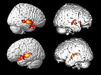 Não của người khỏe mạnh (trái) và não người bệnh (phải) có phản ứng giống nhau