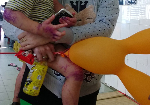 Bệnh thủy đậu thường đột ngột với triệu chứng nổi mụn nước ở vùng đầu mặt, chi và thân Phòng ngừa bệnh thủy đậu