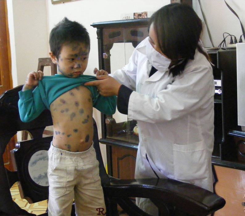 Bệnh thủy đậu nếu nhẹ có thể điều trị tại nhà mà không cần nhập viện Phòng ngừa bệnh thủy đậu