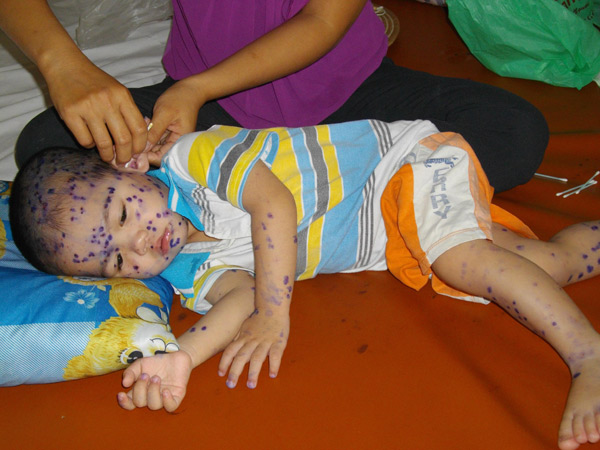 Phòng ngừa bệnh thủy đậu